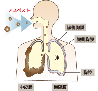 アスベストが肺に入り中皮腫ができる様子